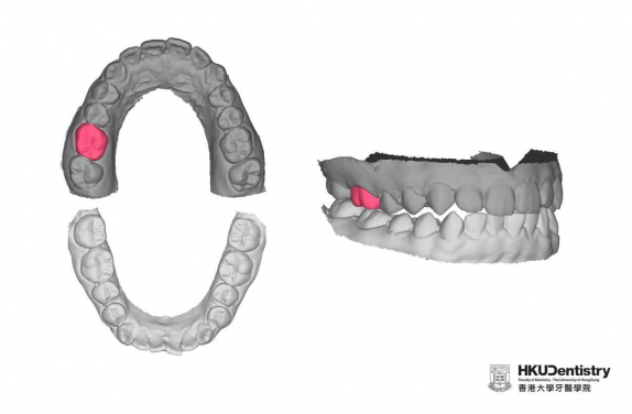 圖二: 研究小組使用3D GAN來學習175名參與學生的牙齒於牙弓中的關係。經過訓練，3D GAN能根據剩餘牙齒（深灰色）的特徵生成牙齒（紅色）。研究小組建議進一步研究上/下顎牙齒的咬合，有助AI製造更自然合適的牙齒（紅色）。